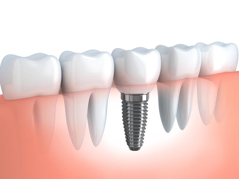 Dental Implants Worcester, MA